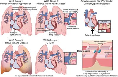 Sex Differences in Right Ventricular Dysfunction: Insights From the Bench to Bedside